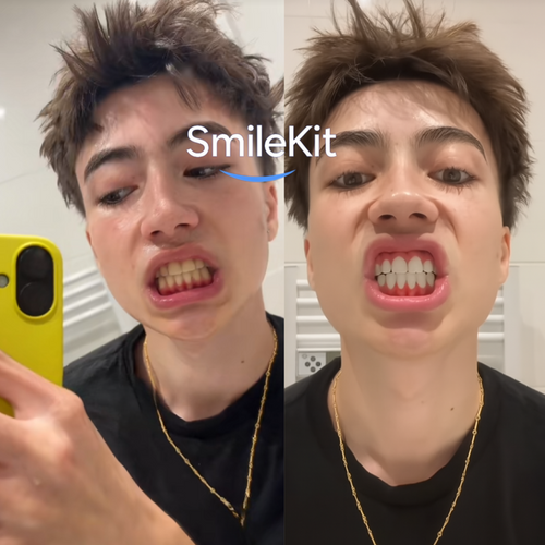 Kit de blanchiment dentaires - Smilekit